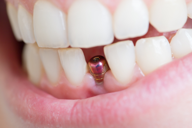 harrell dental implant center charlotte nc single bridge all-on-4 snap-in denture stabilization ballantyne 28277